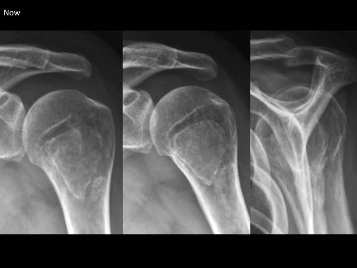 Figure 1 for case simple bone cyst ( RID3945 )